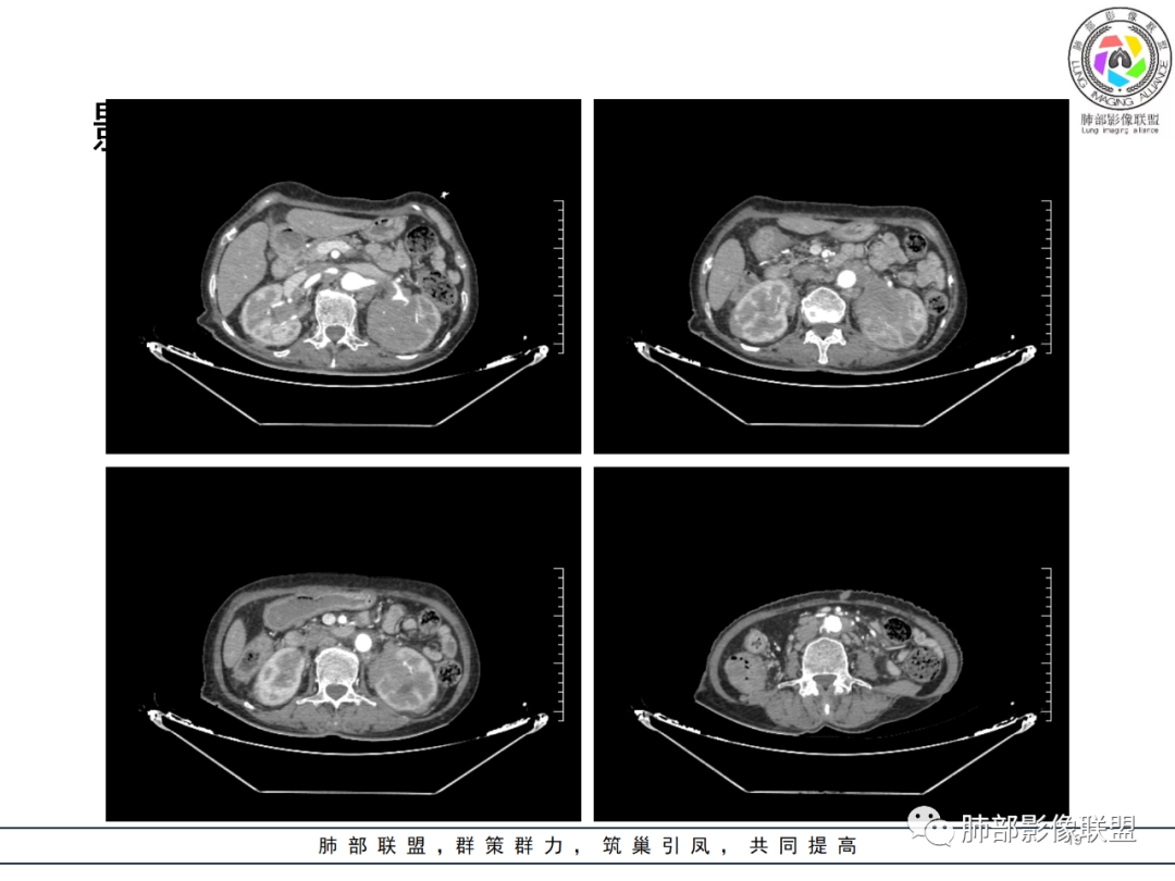 【病例】围绕中轴间质的弥漫大B淋巴瘤-19
