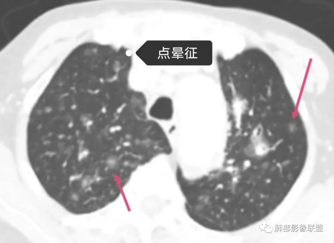 【病例】围绕中轴间质的弥漫大B淋巴瘤-22