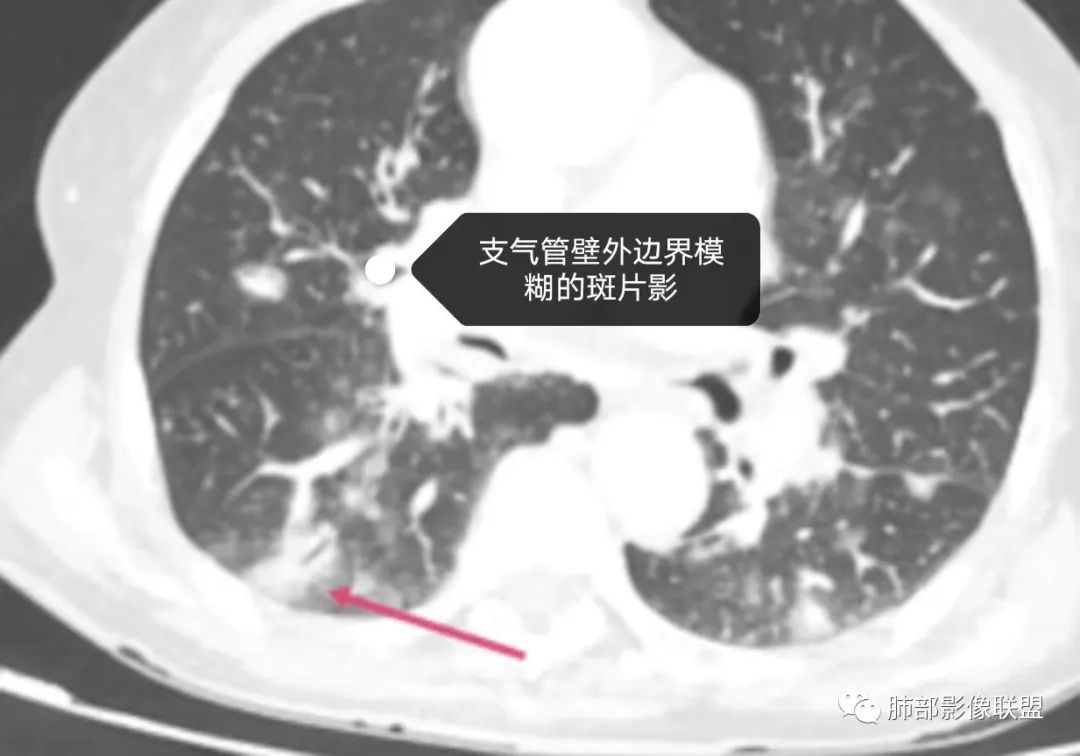【病例】围绕中轴间质的弥漫大B淋巴瘤-23