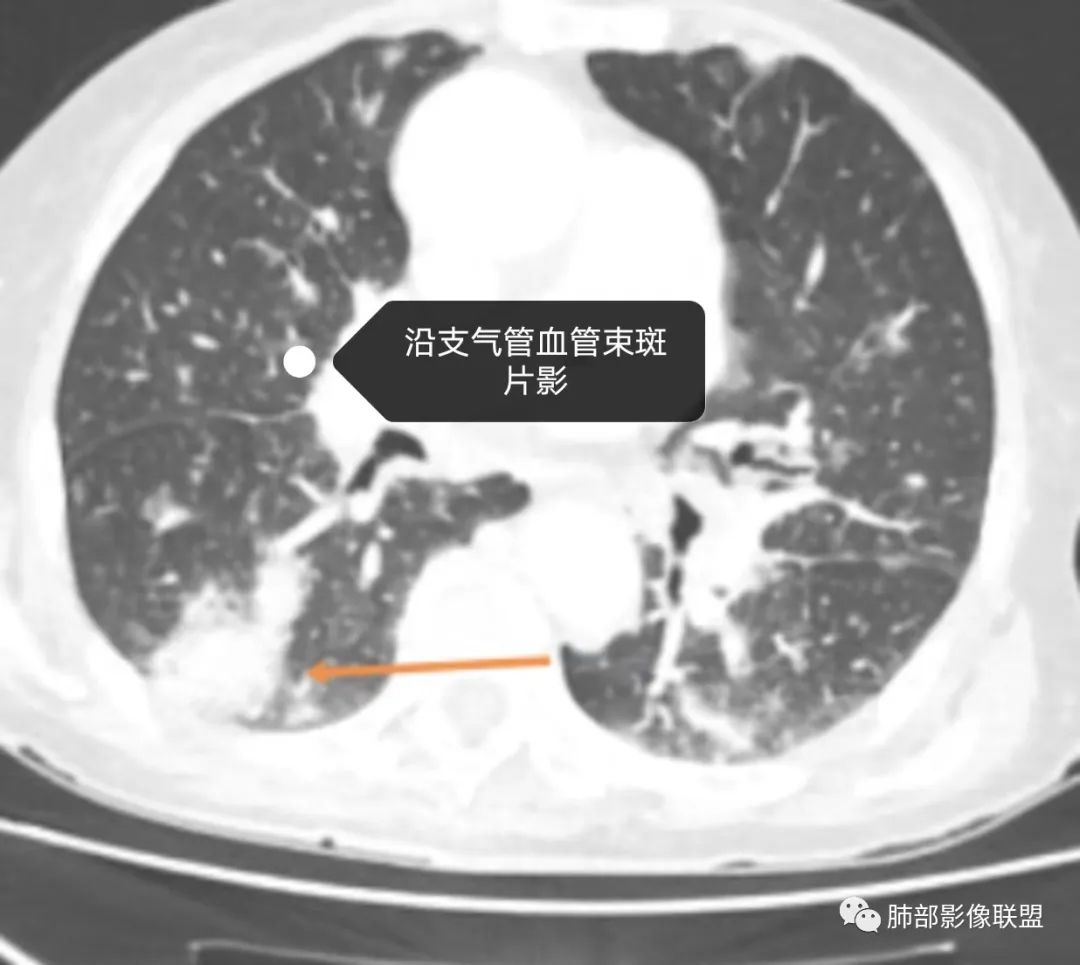 【病例】围绕中轴间质的弥漫大B淋巴瘤-24