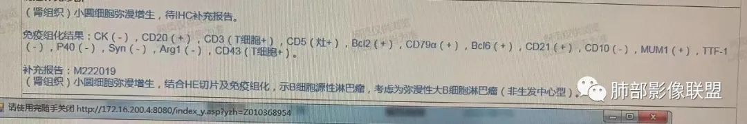 【病例】围绕中轴间质的弥漫大B淋巴瘤-25