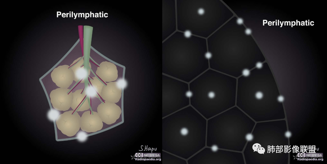 【病例】围绕中轴间质的弥漫大B淋巴瘤-26