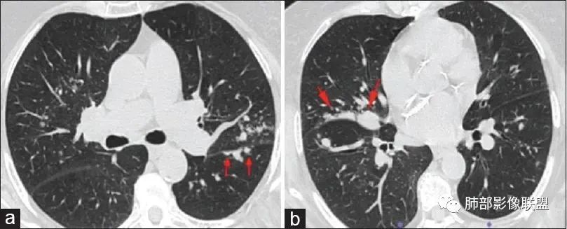 【病例】围绕中轴间质的弥漫大B淋巴瘤-27