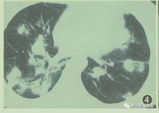 【病例】围绕中轴间质的弥漫大B淋巴瘤-28
