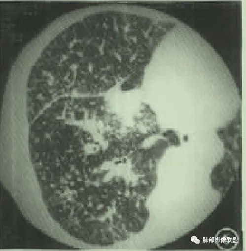 【病例】围绕中轴间质的弥漫大B淋巴瘤-29