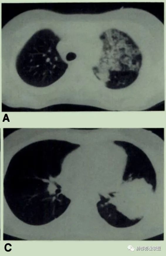 【病例】围绕中轴间质的弥漫大B淋巴瘤-30