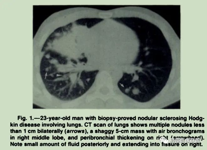 【病例】围绕中轴间质的弥漫大B淋巴瘤-31
