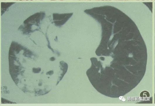 【病例】围绕中轴间质的弥漫大B淋巴瘤-32