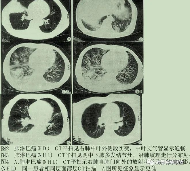 【病例】围绕中轴间质的弥漫大B淋巴瘤-33