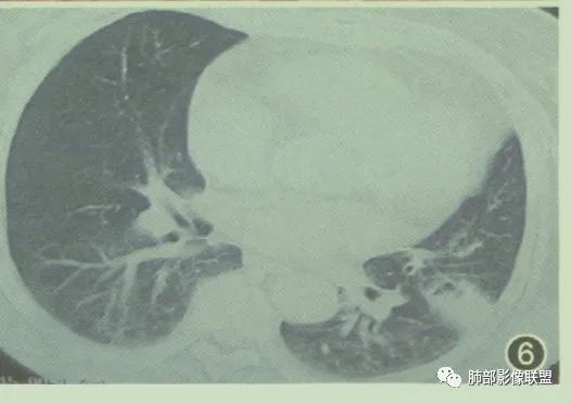 【病例】围绕中轴间质的弥漫大B淋巴瘤-34