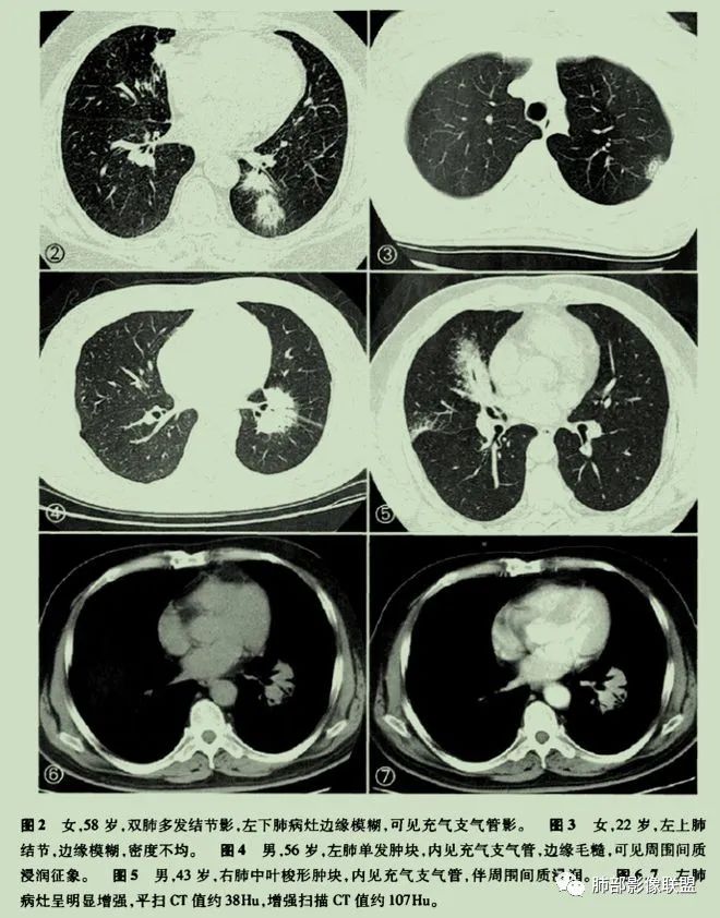 【病例】围绕中轴间质的弥漫大B淋巴瘤-35