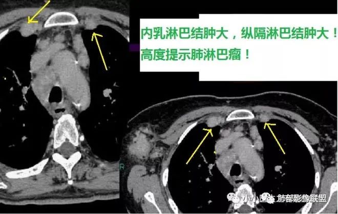 【病例】围绕中轴间质的弥漫大B淋巴瘤-36