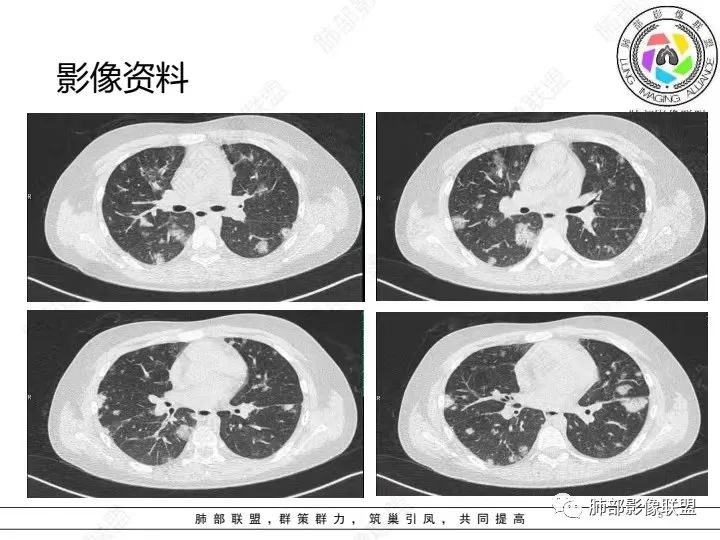 【病例】血源性金黄色葡萄球菌性肺炎1例CT影像-5