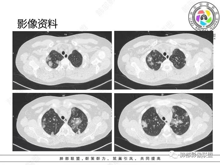 【病例】血源性金黄色葡萄球菌性肺炎1例CT影像-3