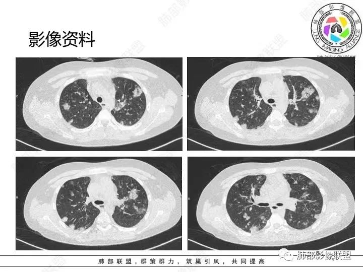 【病例】血源性金黄色葡萄球菌性肺炎1例CT影像-4