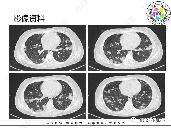 【病例】血源性金黄色葡萄球菌性肺炎1例CT影像-6