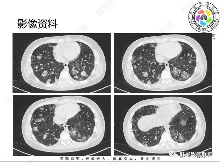 【病例】血源性金黄色葡萄球菌性肺炎1例CT影像-7