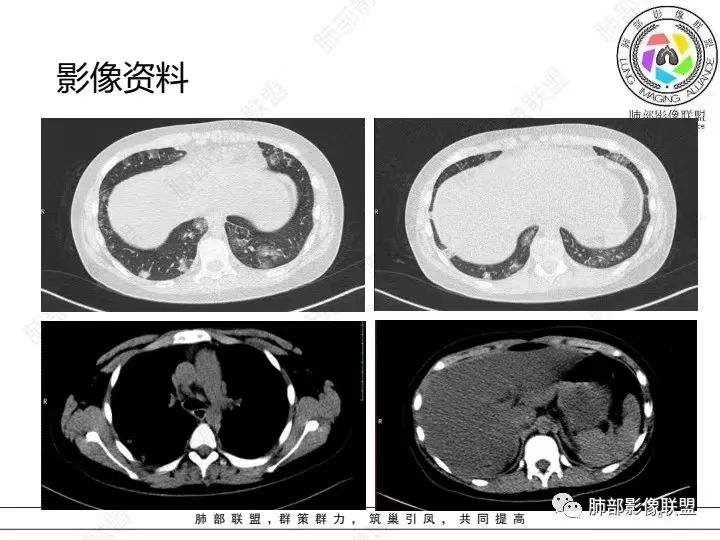 【病例】血源性金黄色葡萄球菌性肺炎1例CT影像-8