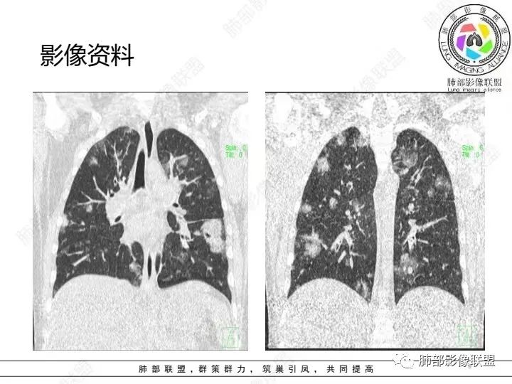 【病例】血源性金黄色葡萄球菌性肺炎1例CT影像-9