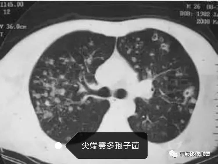 【病例】血源性金黄色葡萄球菌性肺炎1例CT影像-13