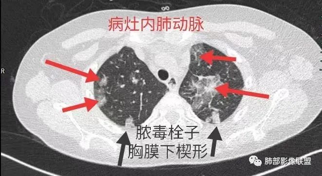 【病例】血源性金黄色葡萄球菌性肺炎1例CT影像-15