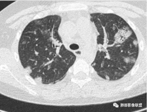 【病例】血源性金黄色葡萄球菌性肺炎1例CT影像-16
