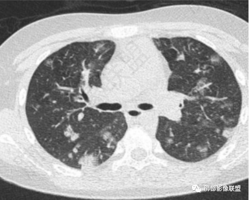 【病例】血源性金黄色葡萄球菌性肺炎1例CT影像-17