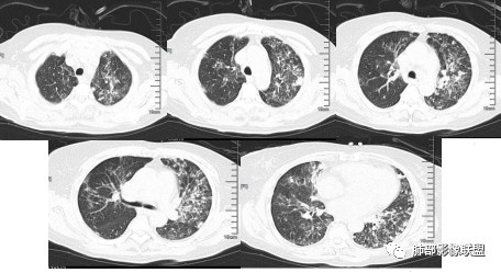 【病例】血源性金黄色葡萄球菌性肺炎1例CT影像-14