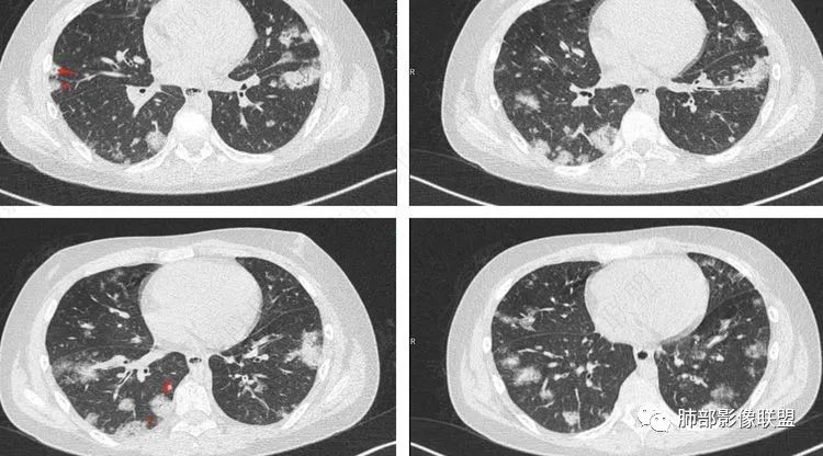 【病例】血源性金黄色葡萄球菌性肺炎1例CT影像-21