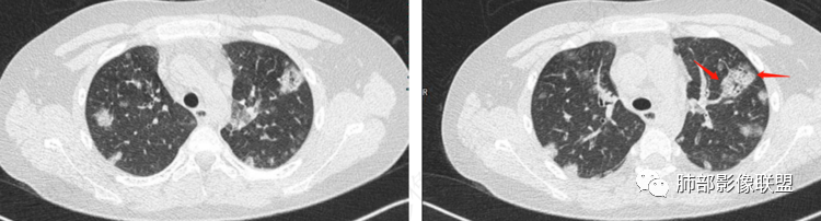 【病例】血源性金黄色葡萄球菌性肺炎1例CT影像-22
