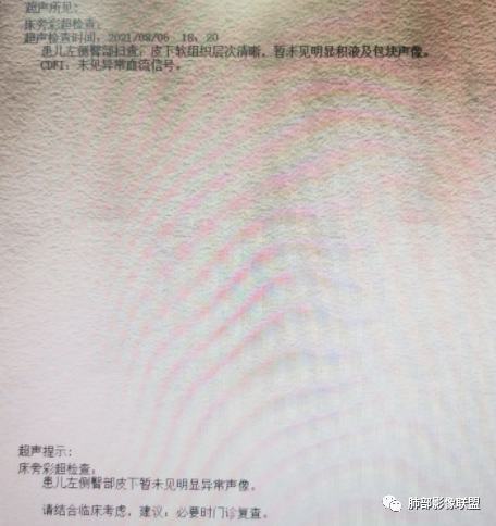 【病例】血源性金黄色葡萄球菌性肺炎1例CT影像-25