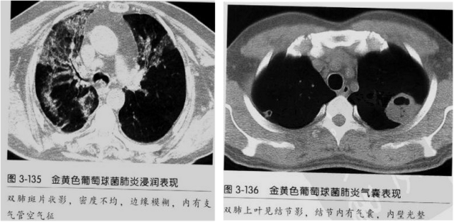 【病例】血源性金黄色葡萄球菌性肺炎1例CT影像-32