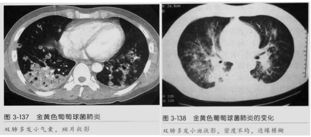 【病例】血源性金黄色葡萄球菌性肺炎1例CT影像-33