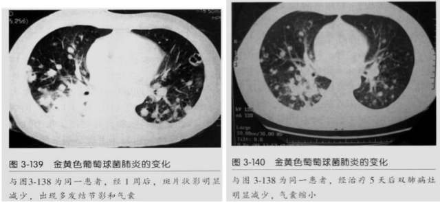 【病例】血源性金黄色葡萄球菌性肺炎1例CT影像-34