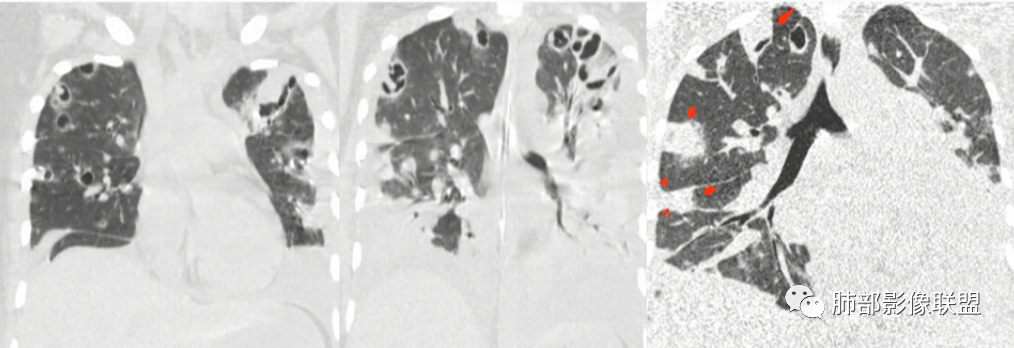 【病例】血源性金黄色葡萄球菌性肺炎1例CT影像-35