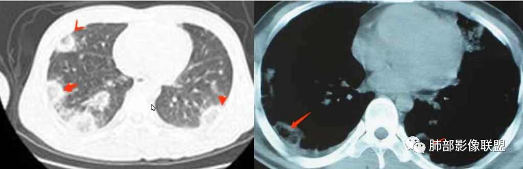 【病例】血源性金黄色葡萄球菌性肺炎1例CT影像-36