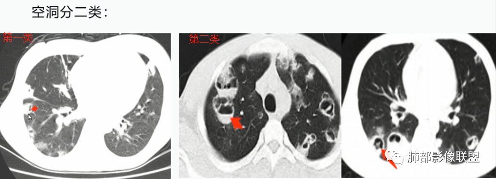 【病例】血源性金黄色葡萄球菌性肺炎1例CT影像-37