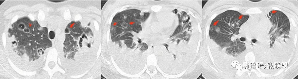 【病例】血源性金黄色葡萄球菌性肺炎1例CT影像-38
