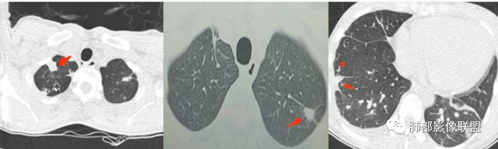 【病例】血源性金黄色葡萄球菌性肺炎1例CT影像-39