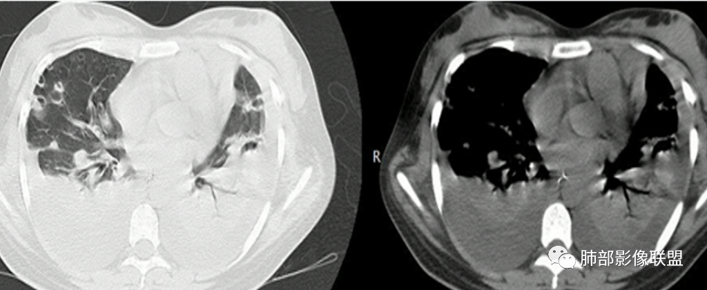 【病例】血源性金黄色葡萄球菌性肺炎1例CT影像-40