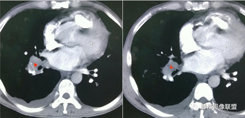 【病例】血源性金黄色葡萄球菌性肺炎1例CT影像-41