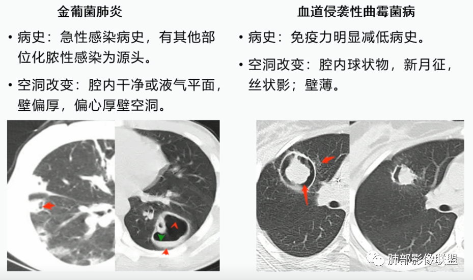 【病例】血源性金黄色葡萄球菌性肺炎1例CT影像-42