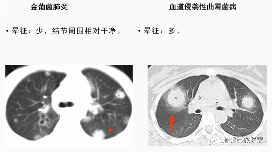 【病例】血源性金黄色葡萄球菌性肺炎1例CT影像-43