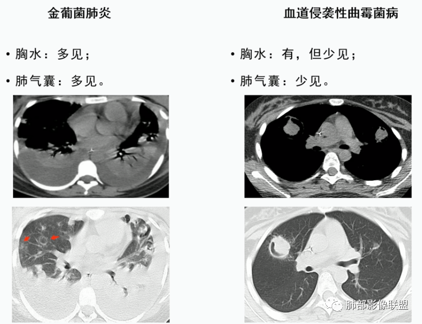 【病例】血源性金黄色葡萄球菌性肺炎1例CT影像-44