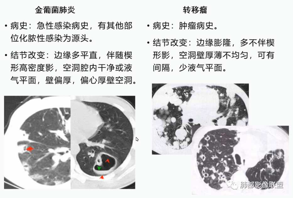 【病例】血源性金黄色葡萄球菌性肺炎1例CT影像-45