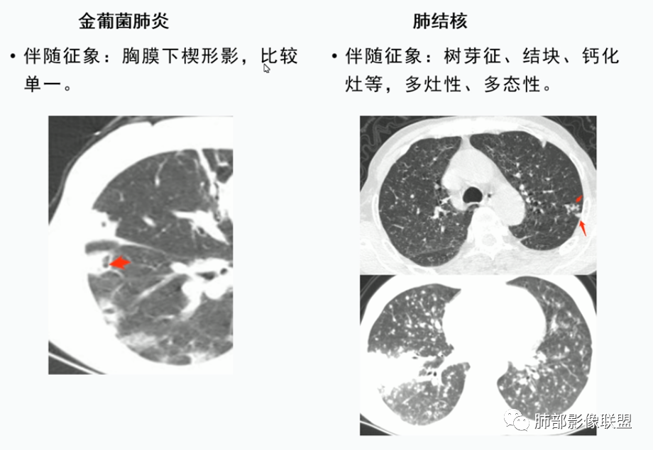 【病例】血源性金黄色葡萄球菌性肺炎1例CT影像-47