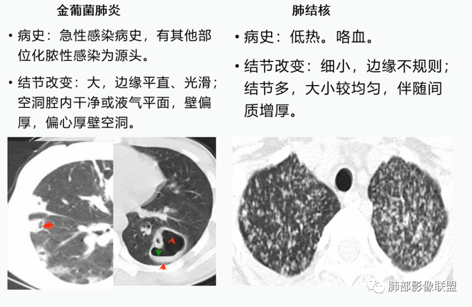 【病例】血源性金黄色葡萄球菌性肺炎1例CT影像-46