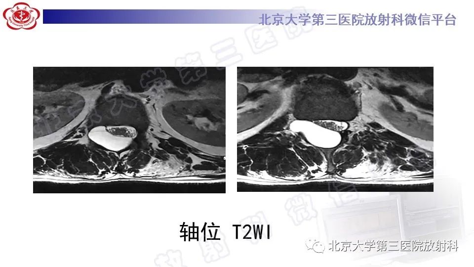【PPT】椎管内脊膜囊肿-7