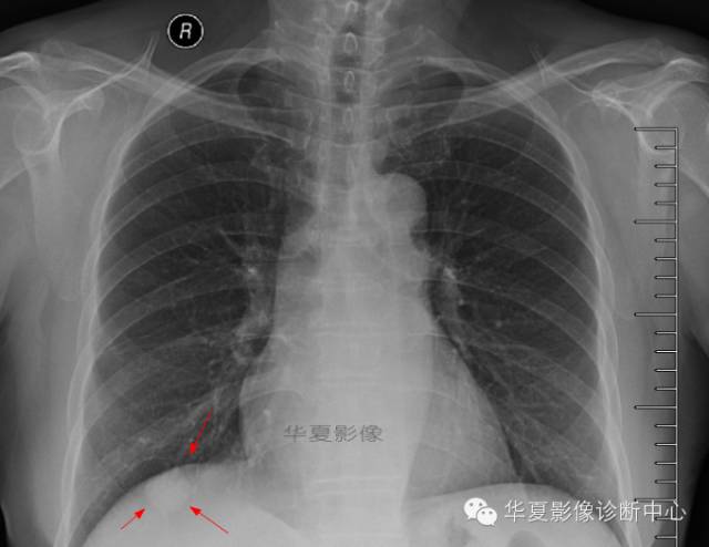 【病例学习】肺错构瘤一例