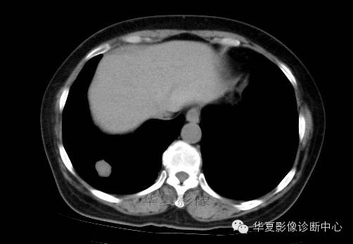 【病例学习】肺错构瘤一例